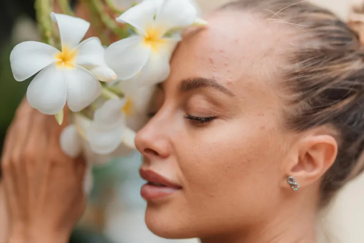Holistic Skincare Routines for Acne-Prone Skin
